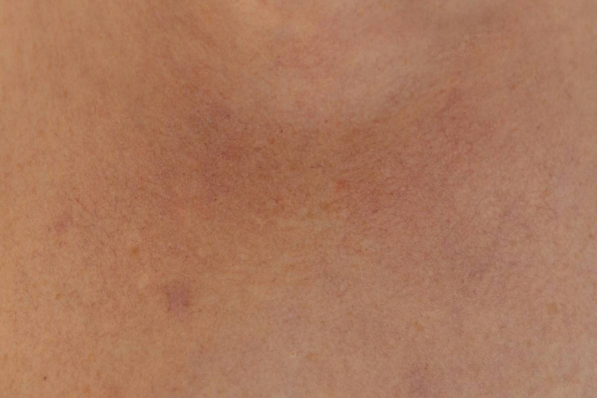 Close-up of irritated skin rash caused by scented pads side effects